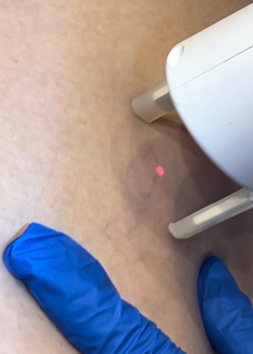Vascular Safety Using Ultrasound Doppler for Filler Injection Cairo 2026
